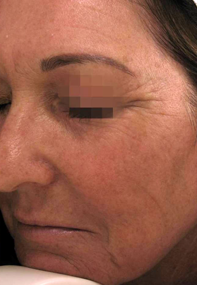 Nekirurški Facelifting - poslije 6