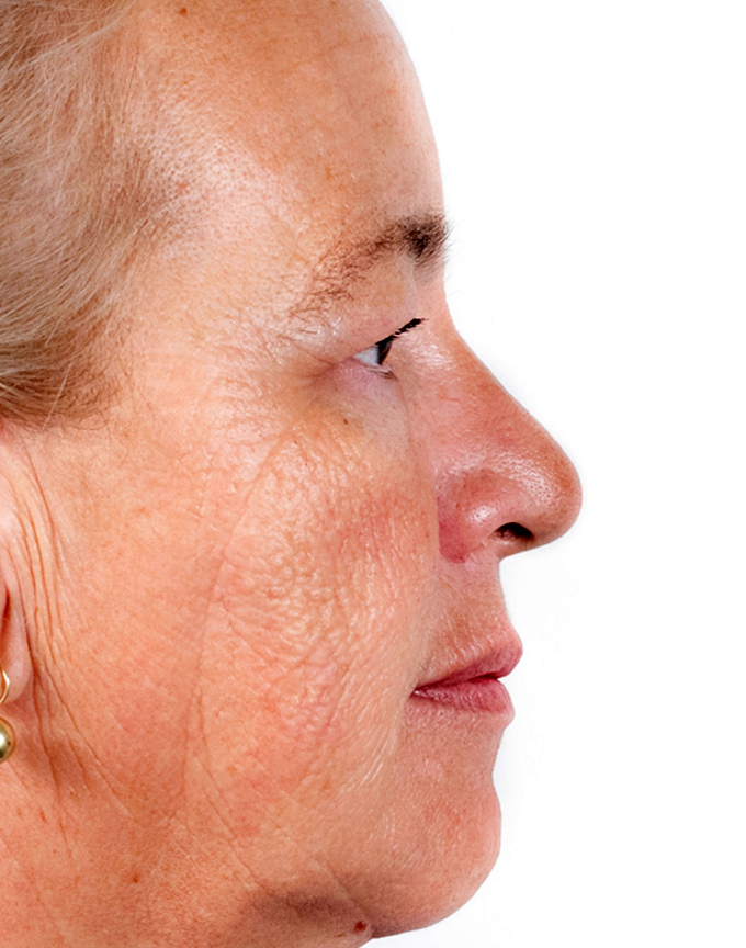 Frakcijski laser, 2021, sl. 1 - poslije