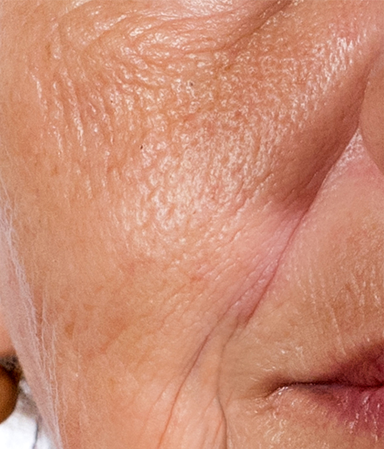 Frakcijski laser, 2021, sl. 3 - poslije