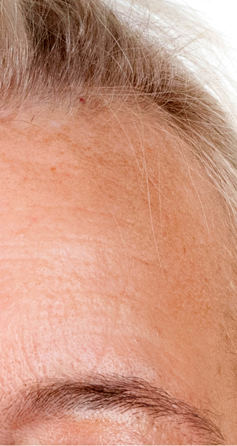 Frakcijski laser, 2021, sl. 4 - poslije