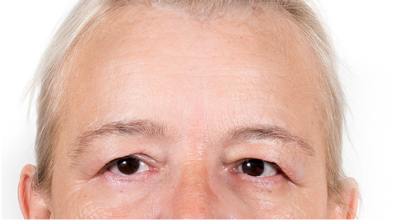 Frakcijski laser, 2021, sl. 6 - poslije