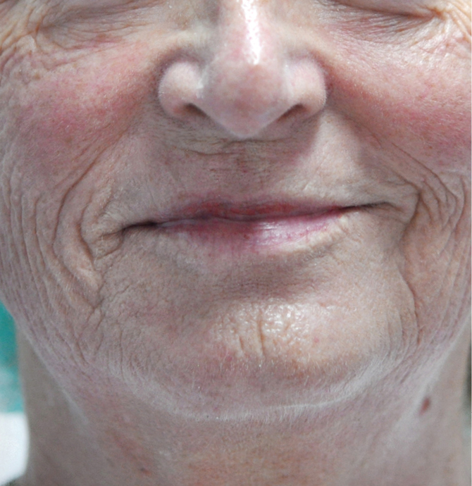 Frakcijski laser - prije 1