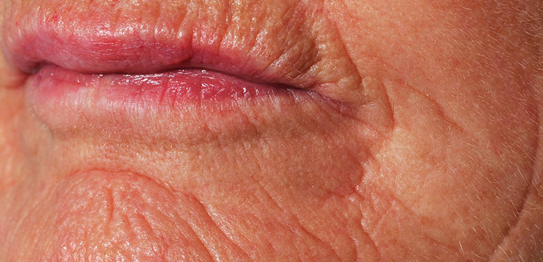 Frakcijski laser - prije 2