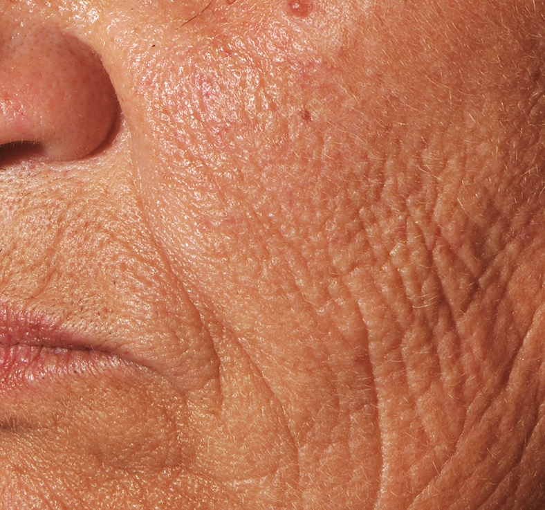 Frakcijski laser - prije 3