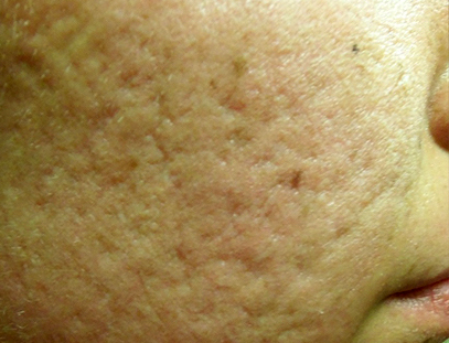 Frakcijski laser - prije 4