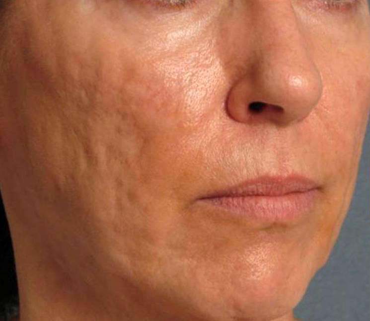 Frakcijski laser - prije 5