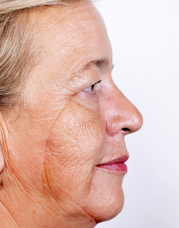 Frakcijski laser, 2021, sl. 1 - prije