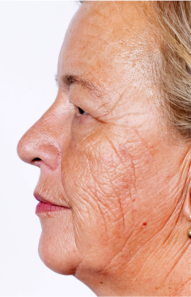 Frakcijski laser, 2021, sl. 2 - prije