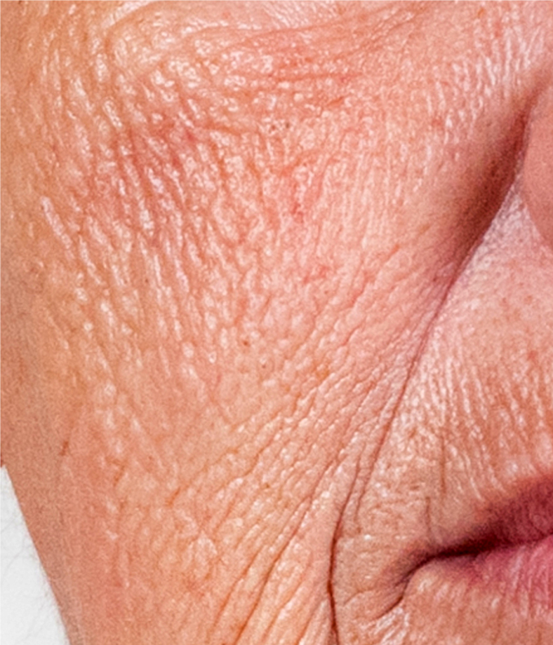 Frakcijski laser, 2021, sl. 3 - prije