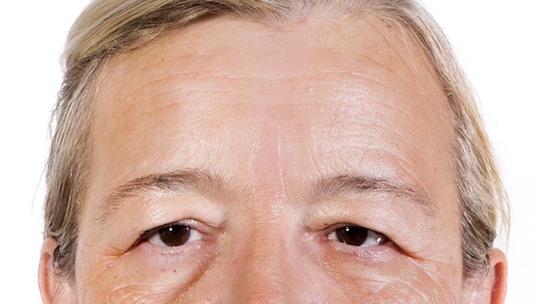 Frakcijski laser, 2021, sl. 6 - prije