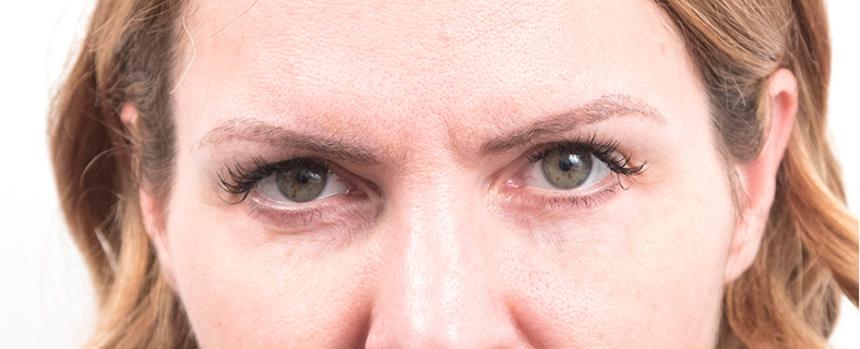 Botox - Injekcije za bore, poslije