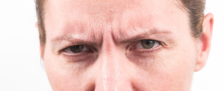 Botox - Injekcije za bore, prije