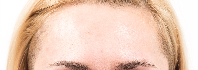 Botox - Injekcije za bore, poslije