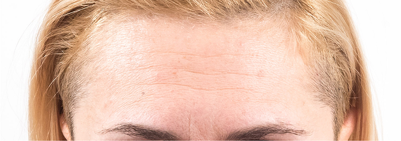 Botox - Injekcije za bore, prije