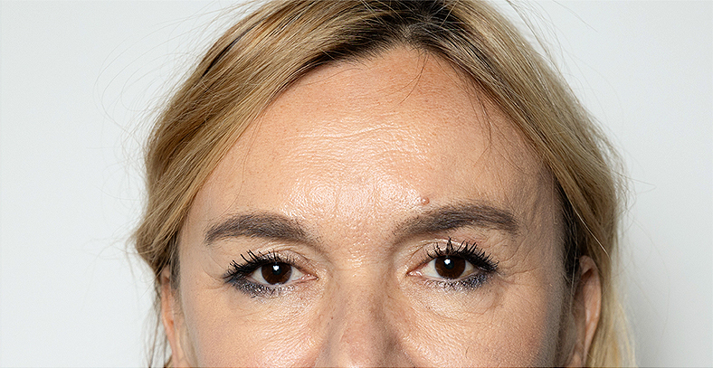 Injekcije za bore, Botox, sl. 1 - poslije