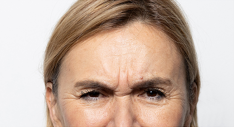 Injekcije za bore, Botox, sl. 2 - prije