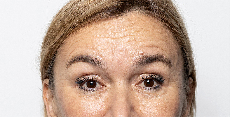 Injekcije za bore, Botox, sl. 3 - prije