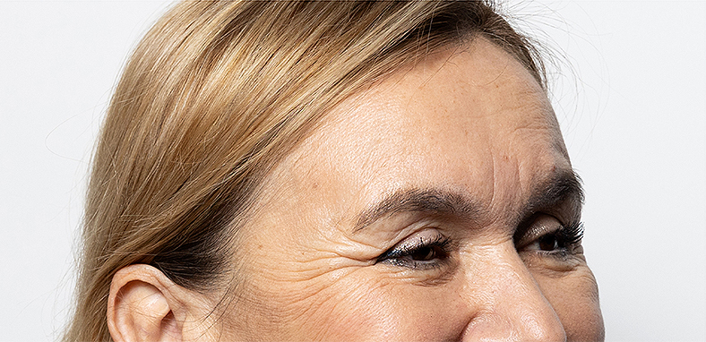 Injekcije za bore, Botox, sl. 4 - prije