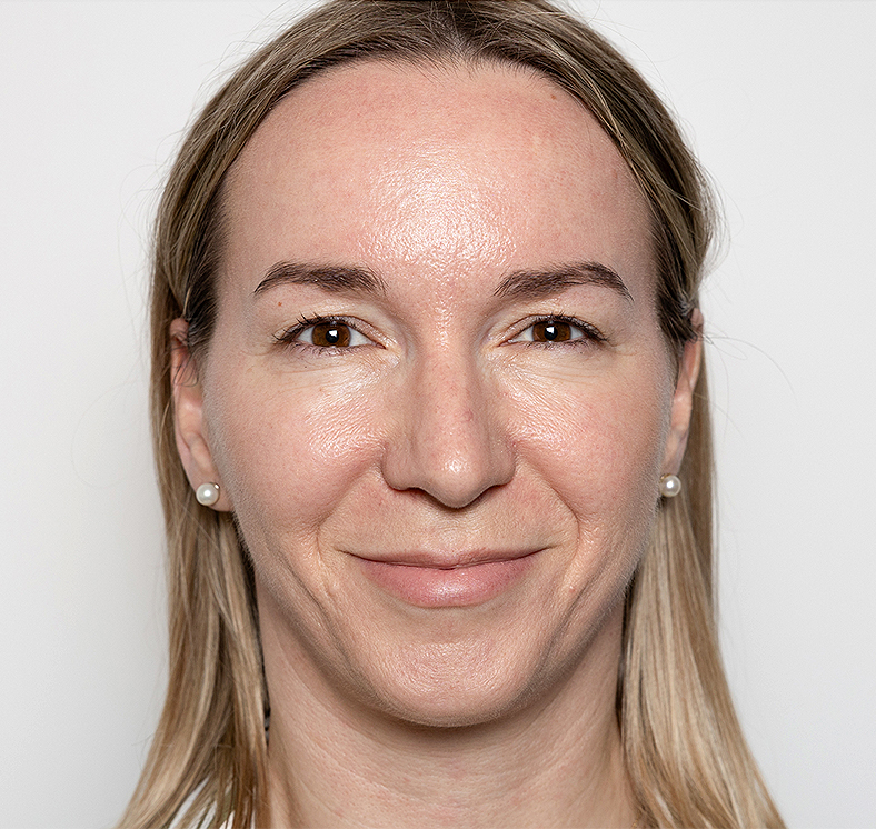 Injekcije za bore, Botox, sl. 2 - poslije