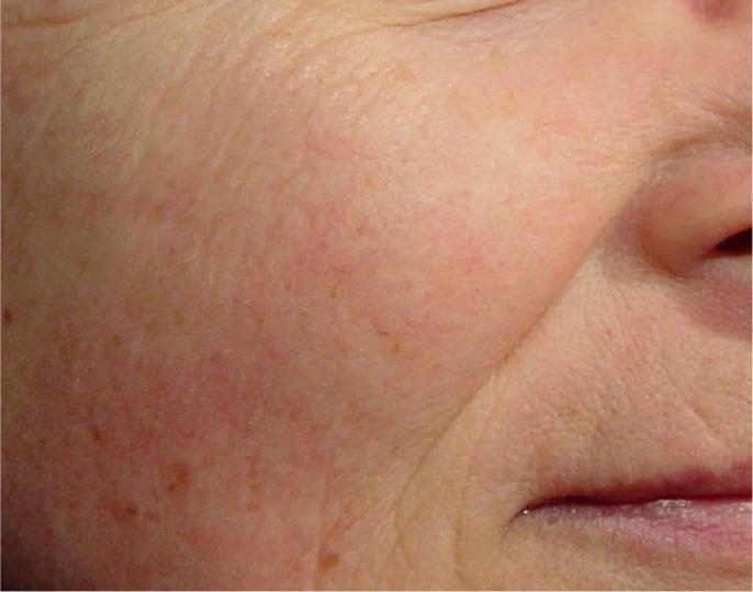 Laser Genesis - poslije 1