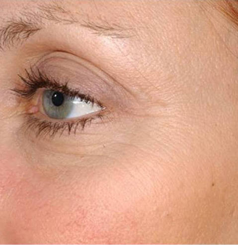 Laser Genesis - poslije 2