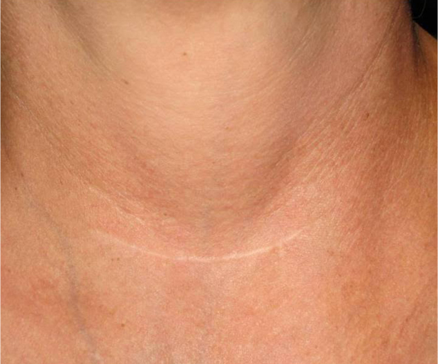 Laser Genesis - poslije 3