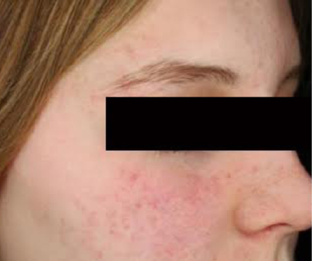 Laser Genesis - poslije 4