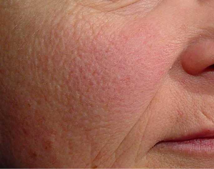 Laser Genesis - prije 1