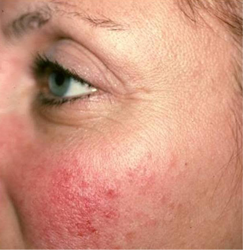 Laser Genesis - prije 2