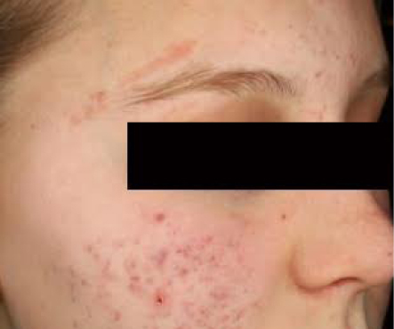 Laser Genesis - prije 4