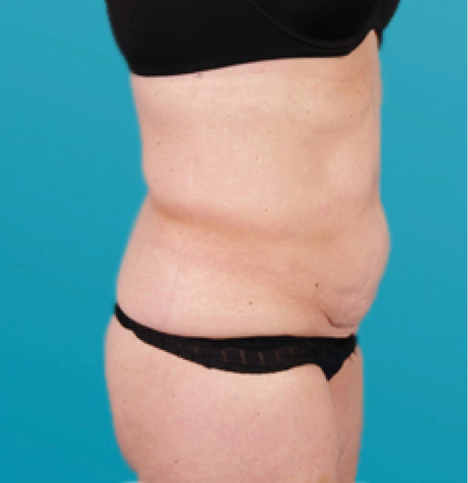 Body Shape - poslije 1