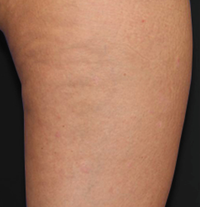 Body Shape - poslije 2