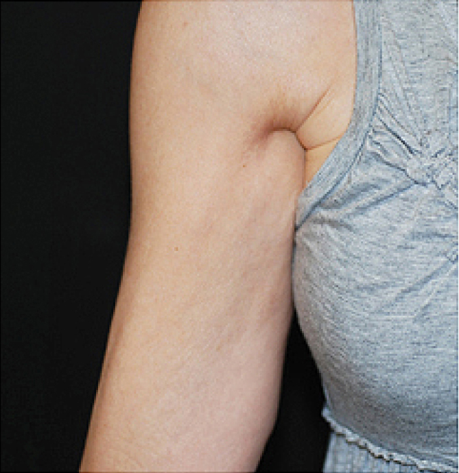 Body Shape and Tight - poslije 2