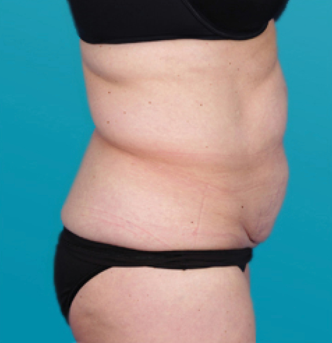 Body Shape - prije 1