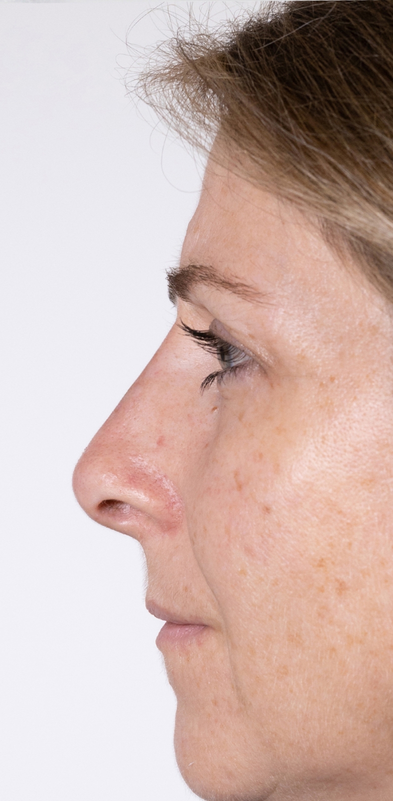 Nekirurška korekcija nosa - poslije, sl. 1 2022