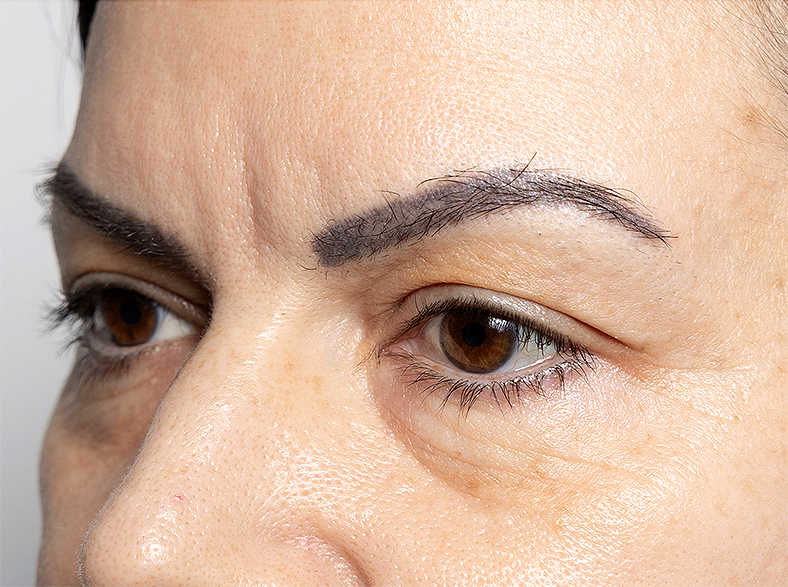 Morpheus8 zatezanjekože, sl. 2 - poslije