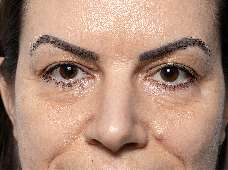 Morpheus8 zatezanjekože, sl. 3 - prije