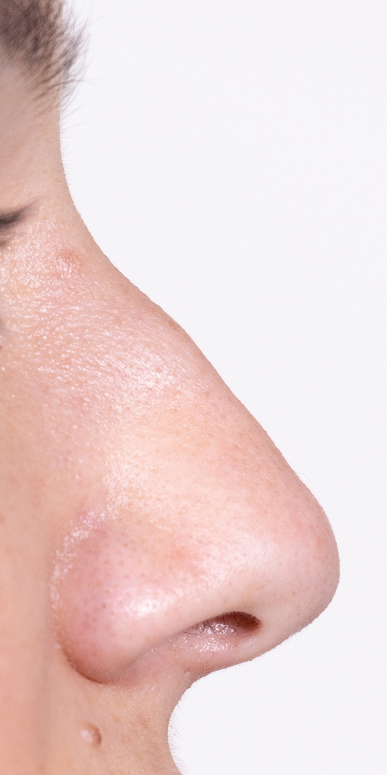 Nekirurška korekcija nosa - prije, sl. 1 2021