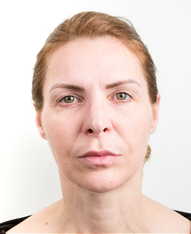 Nekirurški facelifting 1, poslije