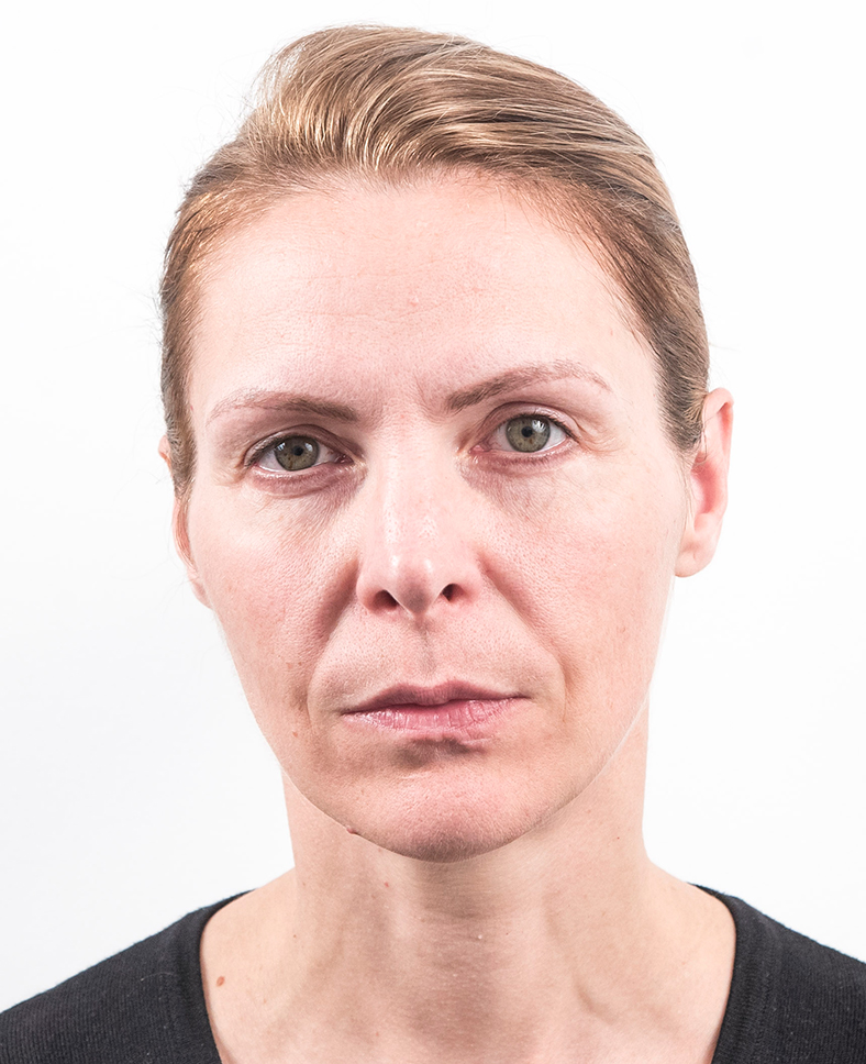 Nekirurški facelifting 1, prije