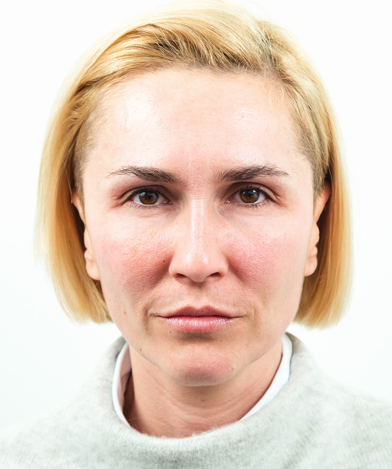 Nekirurški facelifting 2, poslije