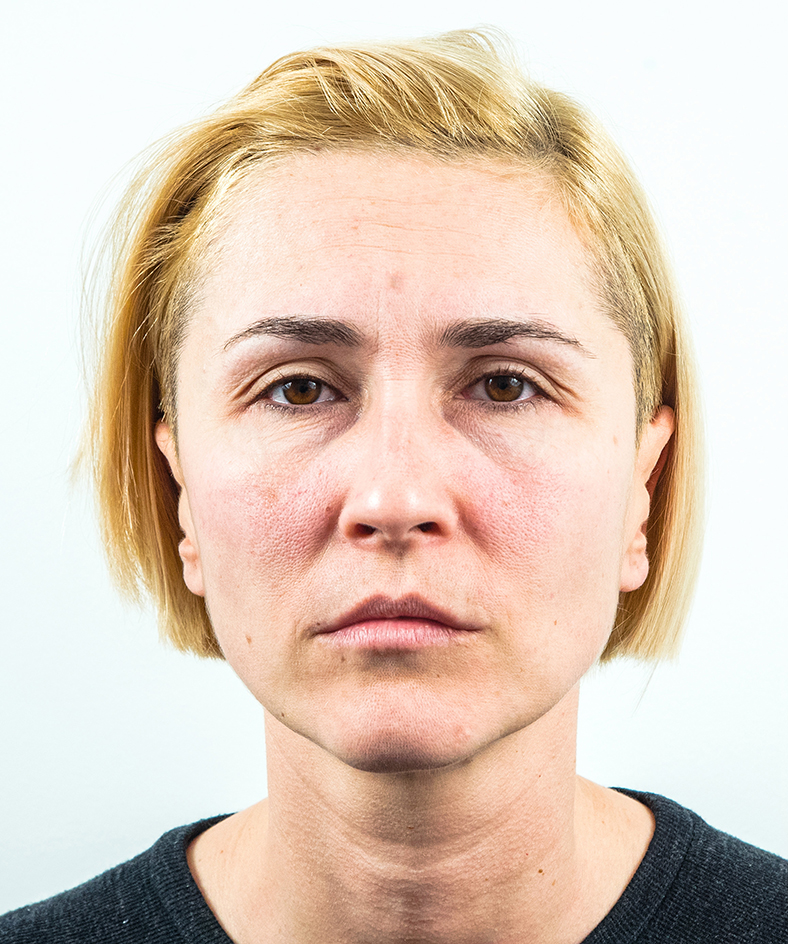 Nekirurški facelifting 2, prije