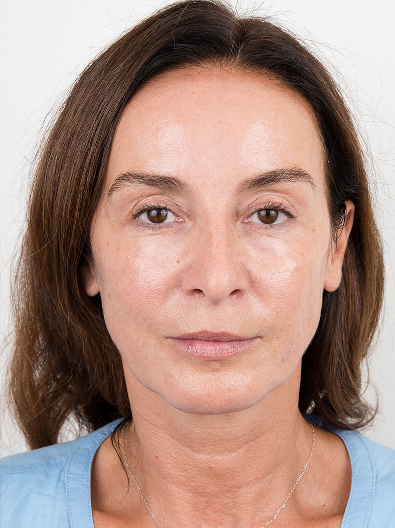 Nekirurški facelifting, poslije