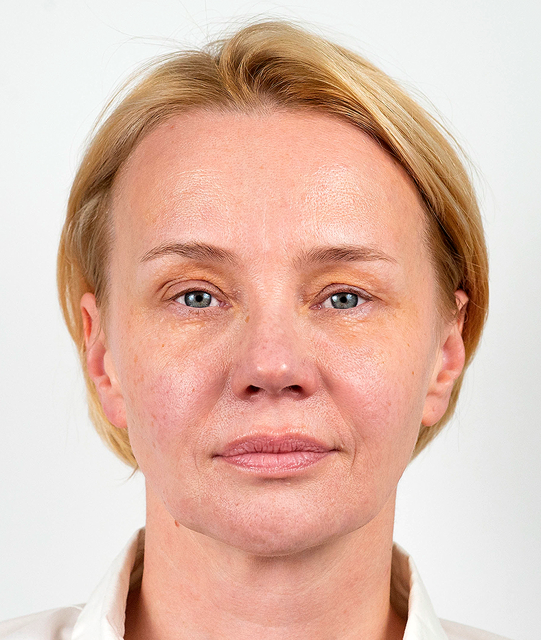 Nekirurški facelifting, poslije, sl. 3