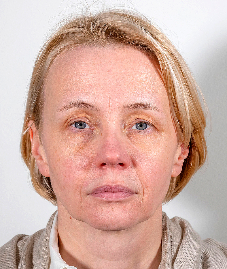 Nekirurški facelifting, prije, sl. 3