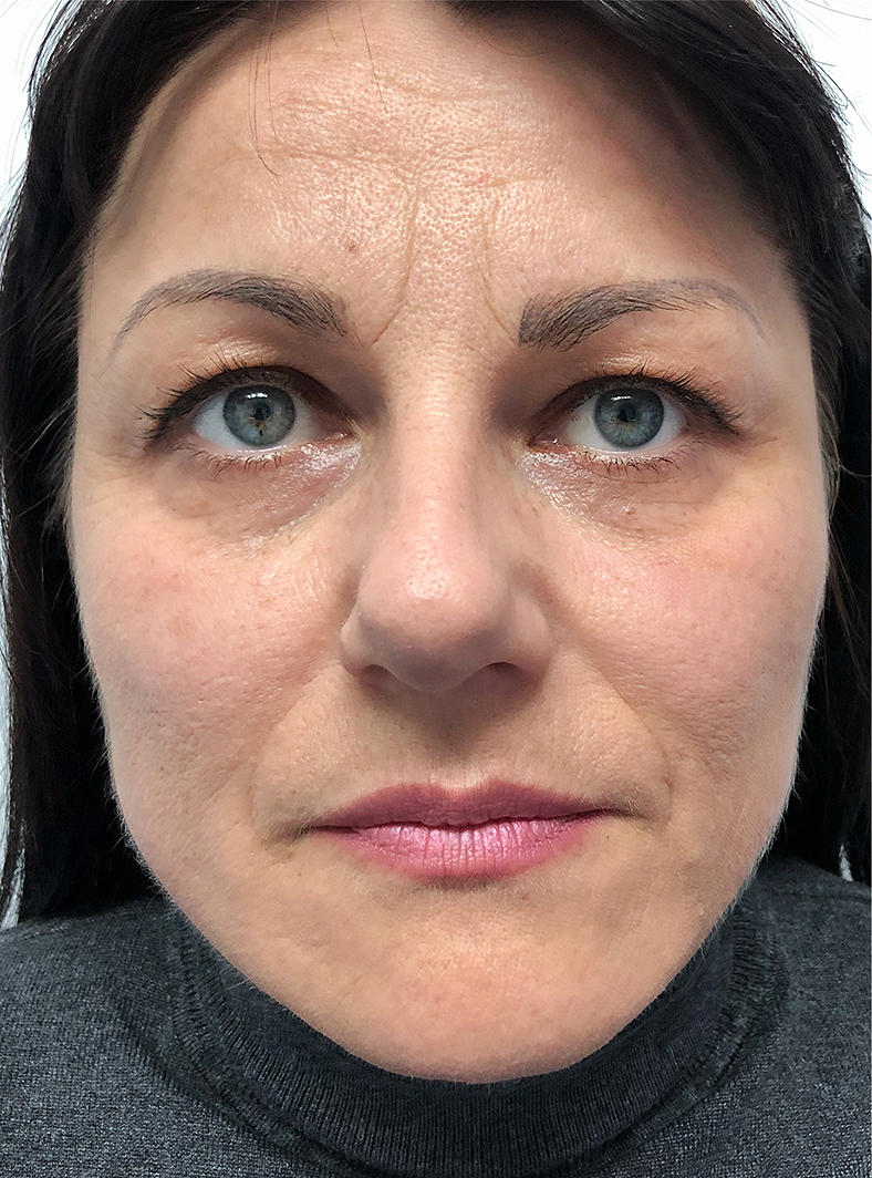 Nekirurški Facelifting - poslije 1