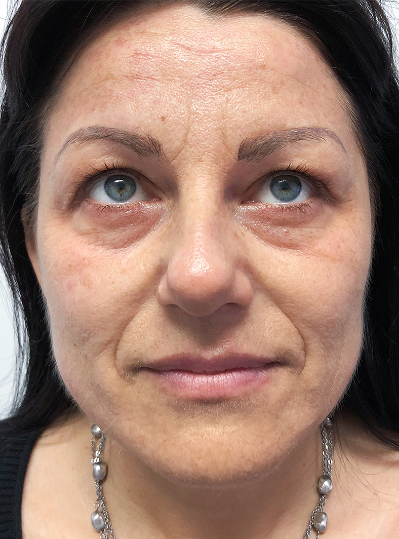 Nekirurški Facelifting - prije 1