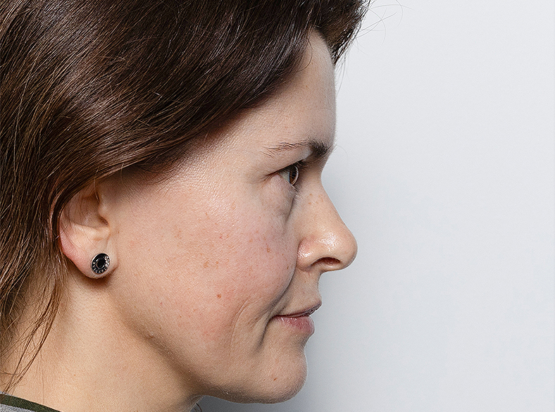 Nekirurško uklanjanje podočnjaka, prije