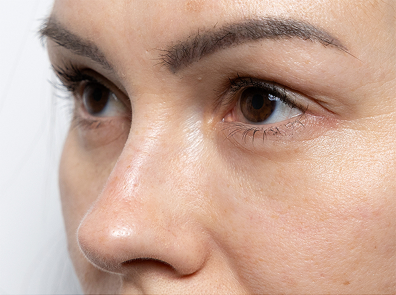 Nekirurško uklanjanje podočnjaka - prije 5