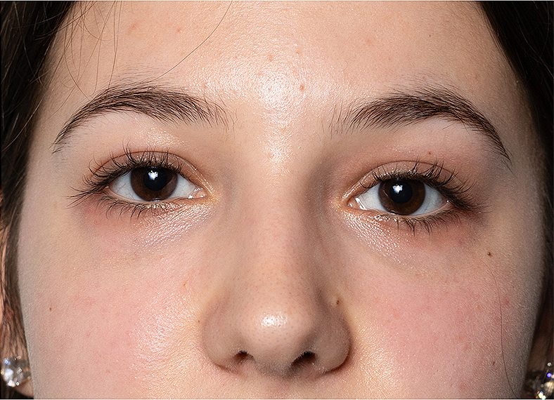 Nekirurško uklanjanje podočnjaka - poslije 3